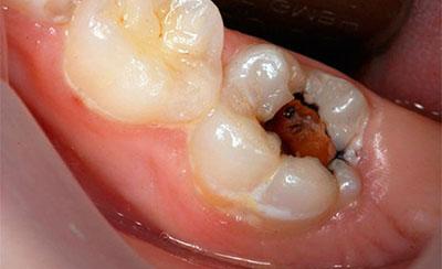 Карієс зуба мудрості, потрібно лікувати або видаляти в разі глибокого ураження