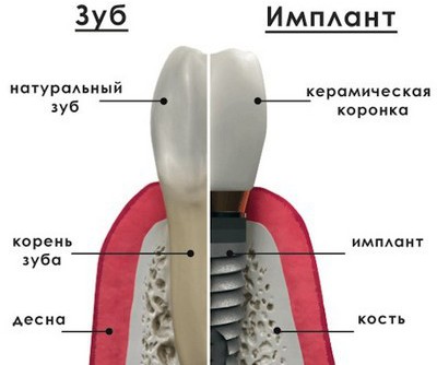 Повна імплантація зубів: заміна на імпланти всієї щелепи, відновлює відразу весь зубний ряд
