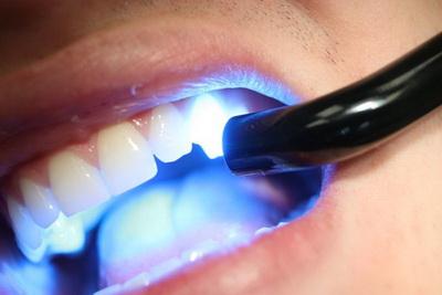 Лазерне відбілювання зубів в клініці: вартість в стоматології, плюси і мінуси, скільки коштує та чи шкідливо відбілювати лазером, фото