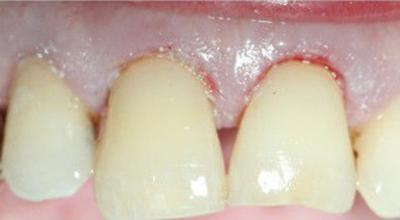 Пришеечный карієс: лікування придесневое, як лікують зуб в домашніх умовах, пломба на глибоку діру у десни, чи можна вилікувати