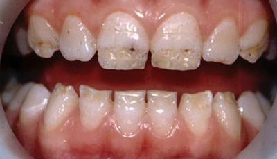 Середній карієс і глибокий за МКБ 10, диференціальна діагностика зубів, EDI, скарги, клінічний перебіг, симптоми, що це таке?