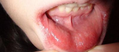 Стоматит фото на десні в роті у дорослих: що це таке, лікування опухлих ясен, чим і як лікувати, від чого зявляється запалення