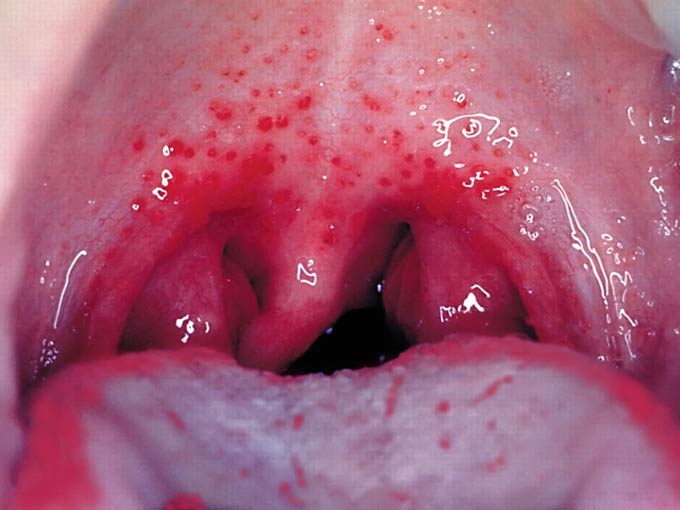Точки в роті (червоні, білі, чорні), енантема у дорослих, лікування