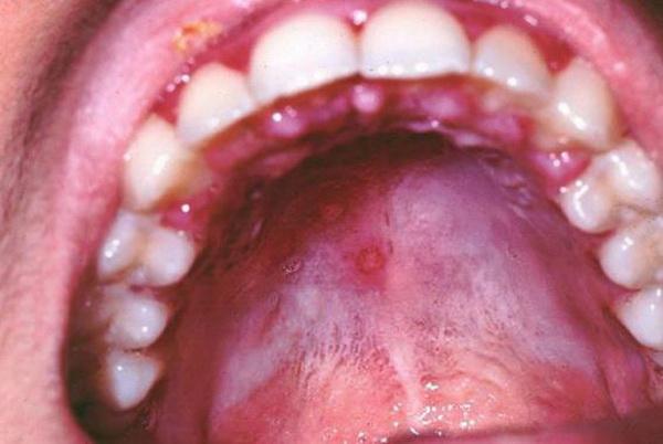 Стоматит на небі: що це таке і чим лікувати у верхній частині рота, фото, а також лікування у дорослих