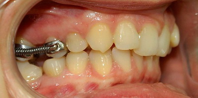 Чи можна ставити брекети, якщо немає одного зуба або не вистачає кількох і як при відсутності ставлять гвинти в щелепу для фіксації
