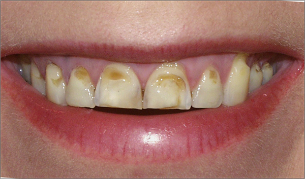 Пришеечный карієс під яснами: придесневій біля основи шийки зуба мудрості, стадії, профілактика шийкового, зубна паста, симптоми