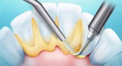 Знімати чи ні зубний камінь: потрібно видаляти будинку, можна палити після чищення, що робити, якщо після видалення болять зуби