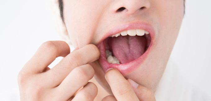Актіномікоз порожнини рота: діагностика, лікування та профілактика