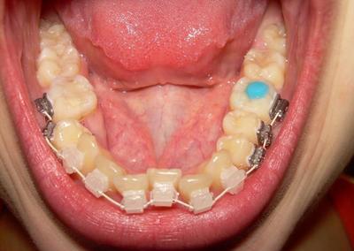 Надкусочные пломби при брекетах, ставлять на пломбовані, нарощені зуби, можна поставити, якщо є імплант або коронка