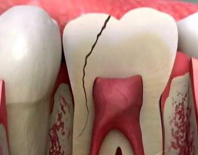 Видалення зламаного зуба мудрості під яснами, як видаляють якщо зламався під корінь і чому важливо видалити