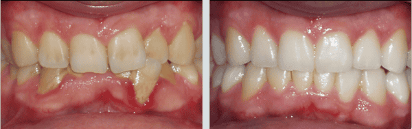 Зняття зубного каменю ультразвуком: як проводять ультразвукову чистку зубів від нальоту, чи боляче робити видалення відкладень
