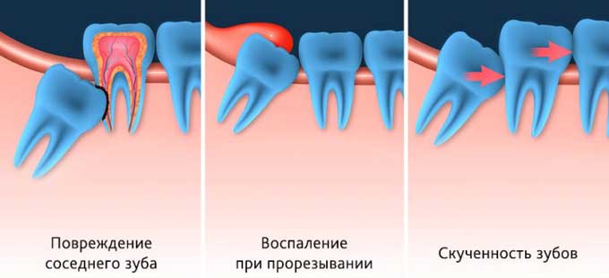Дистопированный зуб: профілактика, діагностика та лікування дистопії