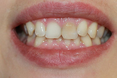 Внутріканальне відбілювання зубів зсередини каналу лазером: що це, внутрикоронковый метод для мертвих і депульпованих, кошти
