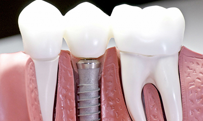 Боляче ставити імплант зуба, що таке зубна імплантація, скільки днів болить і як її робити: вставляти або вкручувати?