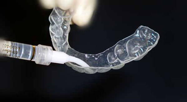 Капи для відбілювання зубів: виготовлення та проведення процедури в домашніх умовах з їх допомогою