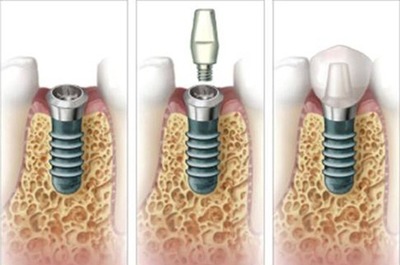 Технологія імплантації зубів: нові розробки в протезуванні без установки імплантів, всі етапи