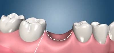 Імплантація зубів: етапи, встановлення зубного імпланту, що встановлюють, як відбувається поетапно, покроковий опис і терміни