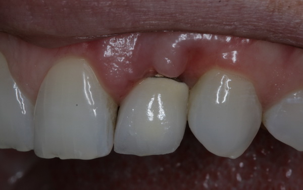 Коли знімають шви після імплантації зубів: на який день це можливо, через скільки часу заживе, як лікувати якщо розійшлися