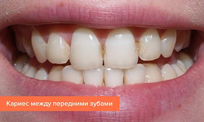 Лікування карієсу передніх зубів, боляче лікувати пришеечный випадок, як прибрати в стоматології і що робити