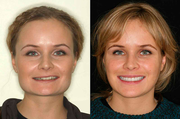 Як змінюється обличчя після брекетів, чому змінюють його форму, які саме зміни, як змінився людина: фото до і після носіння