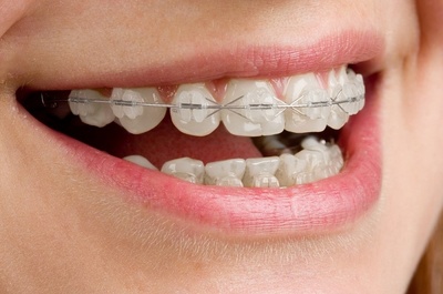 Для чого потрібні брекети, що це таке, навіщо вони в лікуванні, виправляють чи щілини між кривими зубами, допоможуть вирівняти їх
