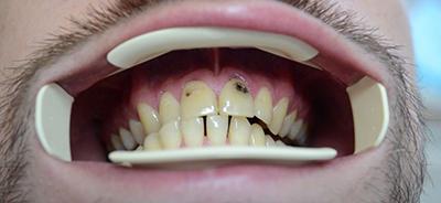 Лікування карієсу передніх зубів, боляче лікувати пришеечный випадок, як прибрати в стоматології і що робити