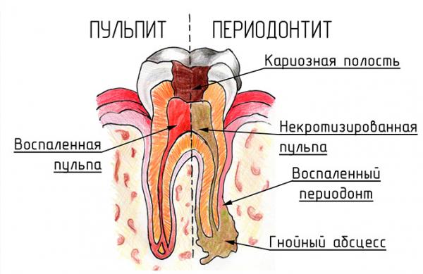 Чим лікують зубний біль: лікування хворого, симптоми хвороби, видалення хворого, якщо болить зуб