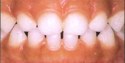 Карієс молочних зубів у дітей за Комаровським: ранній на тимчасових дитячих передніх, циркулярний, глибокий, пришеечный у дитини