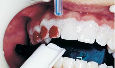 Відбілювання зубів opalescence: система опалесценс буст, домашнє boost xtra з капами, що це таке