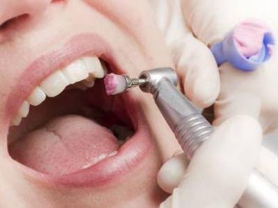 Чищення та відбілювання зубів: що краще і чим відрізняються один від одного