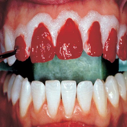 Хімічне відбілювання зубів системою opalescence, етапи проведення процедури