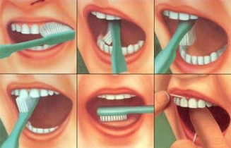 Профілактика зубного каменю. Як запобігти появі зубного каменю?