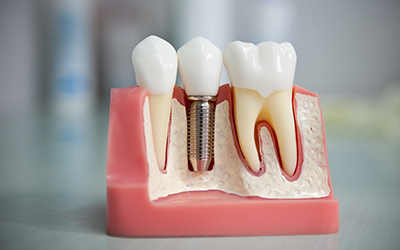 Дентальна імплантація: планування операції з внутрішньокісткової системі зубів, показання та протипоказання