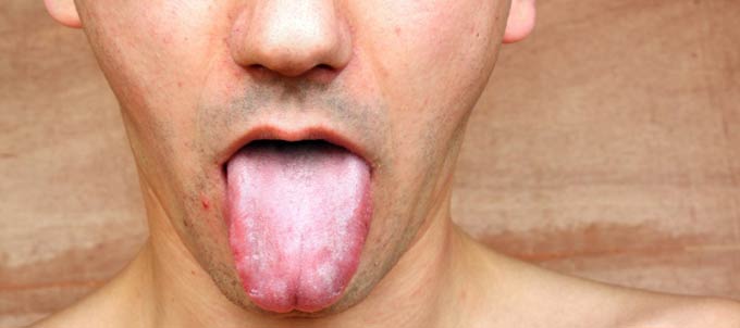 Білий наліт на язиці   причини виникнення у дітей і дорослих