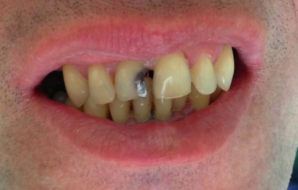 Карієс між передніми зубами: методи лікування міжзубних поразок, як лікувати захворювання запущене вигляді