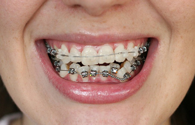 Брекети на 2 щелепи: обовязково ставити на обидві, розширення, чому не ставлять на останні задні зуби, до і після виправлення