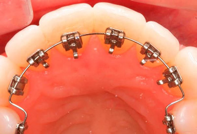 Лінгвальні брекети: що це таке, установка невидимою, внутрішньої, непомітною системи incognito в стоматології, фото до і після