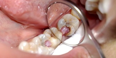 Пульпіт зуба: що це таке, як лікувати у дорослих лазером, лікується, як вилікувати в домашніх умовах, який кладуть ліки