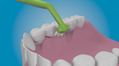 Після імплантації зубів рекомендації: післяопераційний період, реабілітація, що не можна робити, відновлення, чим полоскати рот