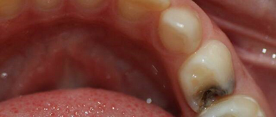 Лікування пульпіту молочних зубів у дітей: що це таке, як лікувати тимчасові одне відвідування або видаляти, етапи, де вилікувати