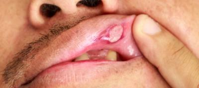 Фукорцин при стоматиті у дітей і дорослих: можна мазати порожнину рота, спосіб застосування