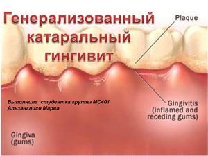 Катаральний гінгівіт. Лікування катаральної форми гінгівіту, фото.