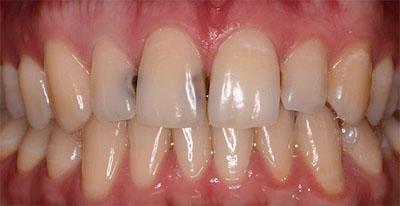 Карієс між зубами: контактний міжзубний, що це таке, причини виникнення між жувальними біля десни або на стику корінних