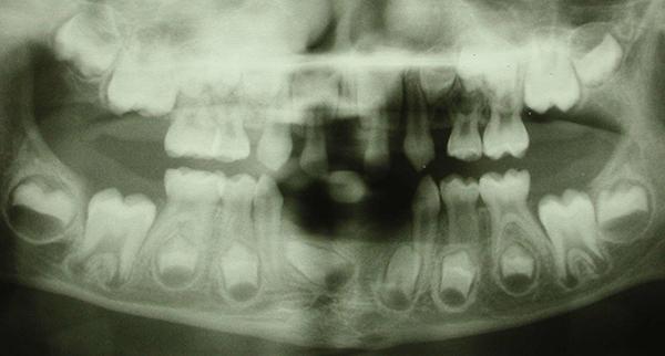 Карієс молочних зубів у дітей за Комаровським: ранній на тимчасових дитячих передніх, циркулярний, глибокий, пришеечный у дитини