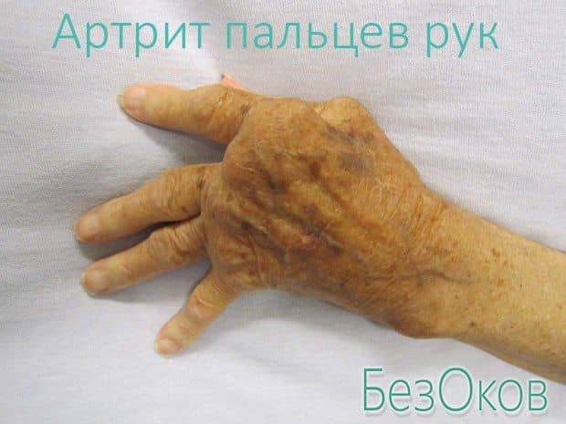 Причини виникнення та особливості лікування артриту кистей рук