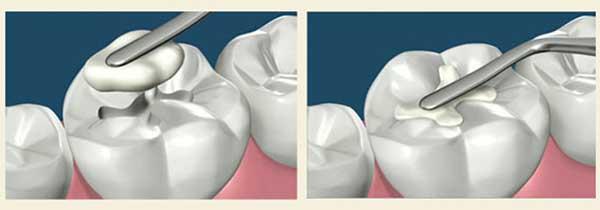 Прикореневій карієс: лікування передніх зубів, що робити, як лікують
