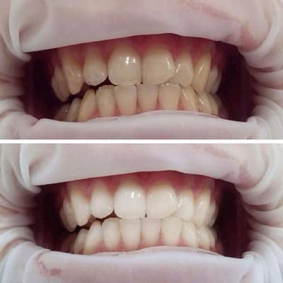 Відбілювання зубів Amazing White: система Амазинг вайт