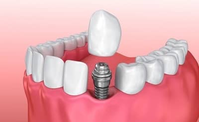 Імплантація нижніх зубів жувальних: який імплант і протез краще поставити на щелепу, небезпечно ставити етапи протезування