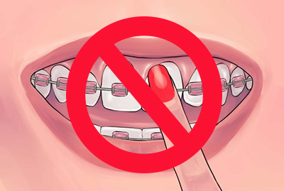 Біль в зубах при брекетах і після, що робити, якщо болять, як прибрати і полегшити, зубне знеболювальне при носінні