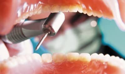Пульпіт: боляче лікувати і видаляти зуб, з уколом анестезії